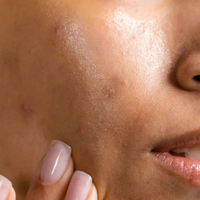 Acne & Breakout