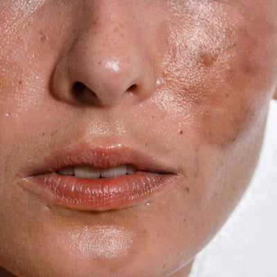Dark Spot & Marks